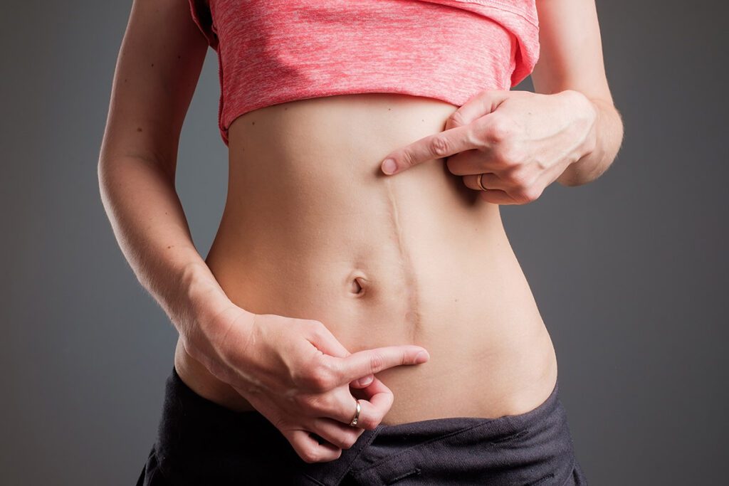 A woman showing a long scar on her abdomen from a prior surgery.