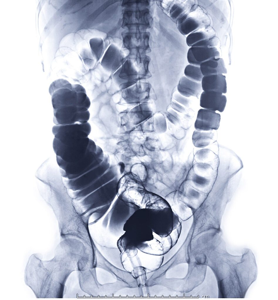 An xray of the colon and rectum.