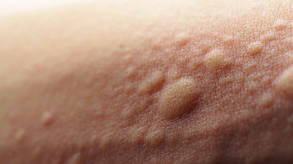 Bumps on the skin.